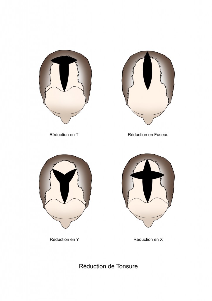 la-r-duction-de-tonsure-la-m-decine-esth-tique-avec-le-dr-haddad
